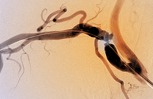 A coloured angiogram showing guide wires in an artery.