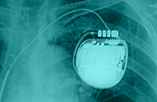 chest x-ray showing implanted pacemaker.