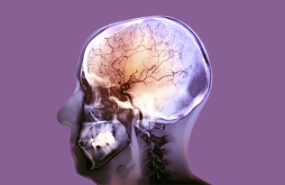 a scan showing the major blood vessels in the brain of someone who has had a stroke.