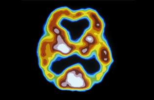 a scan showing the brain of somebody with vascular dementia